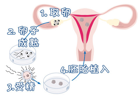 42岁二胎案例